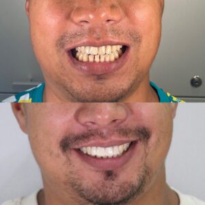 Протезирование с восстановлением высоты зубов и прикуса