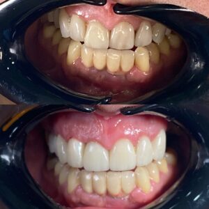 Замена металлокерамических коронок на верхних зубах на коронки керамические Е-мах