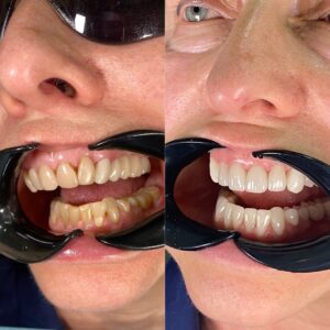 Восстановление зубов рефракторными винирами